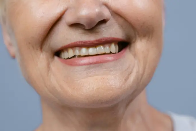 Dental implants