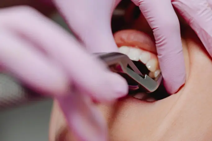 Extractions