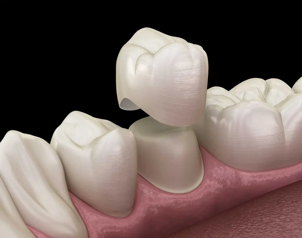 Dental crown placement illustration by Beamsville Smiles Family Dentistry