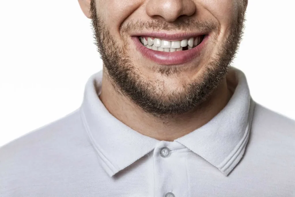 Man with missing tooth showing results before dental extraction at Beamsville Smiles Family Dentistry