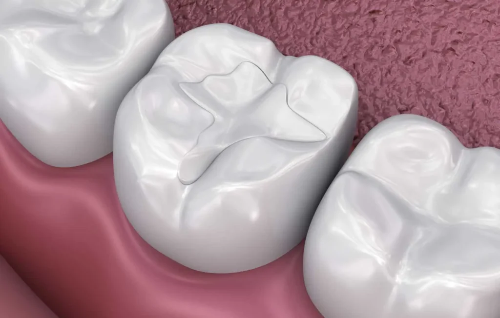 Composite tooth filling illustration by Beamsville Smiles Family Dentistry